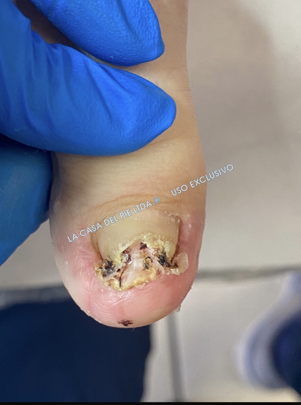 Pedicure clínico, antes del procedimiento