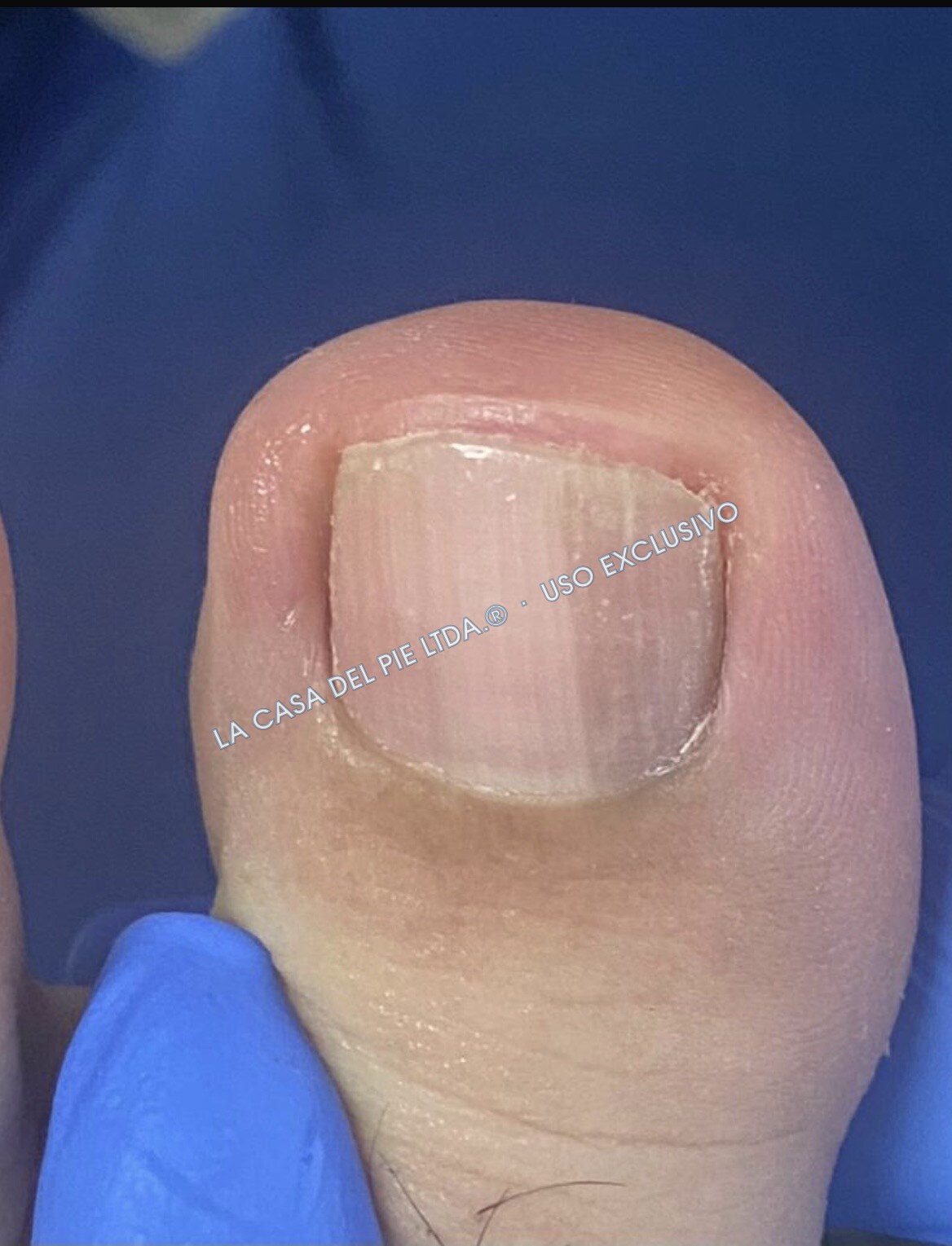 Onicomicosis, después del procedimiento