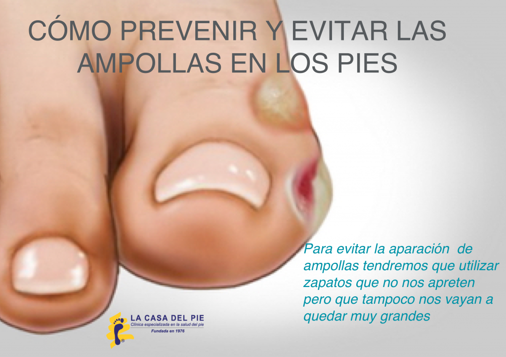 Como prevenir las ampollas en los pies